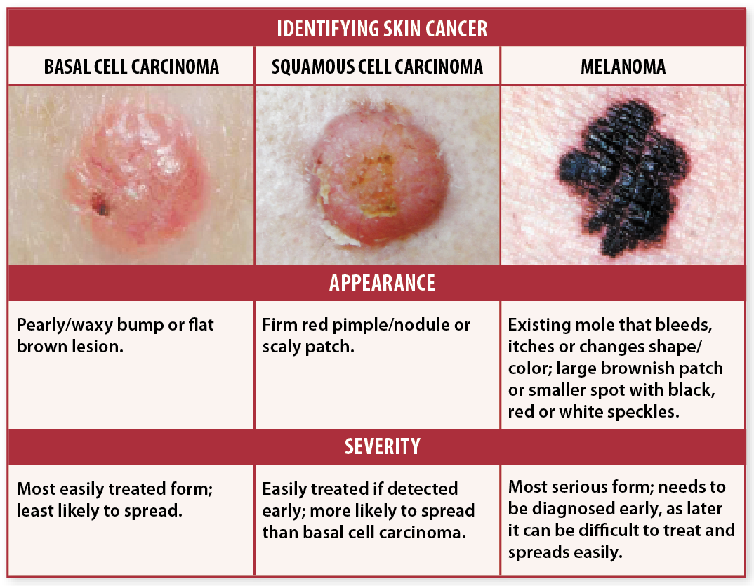 skin cancer